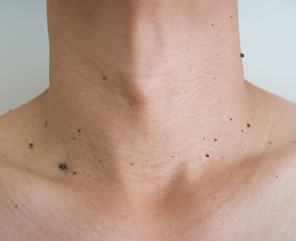 Dermatolojik Tedaviler ben et beni tedavisi