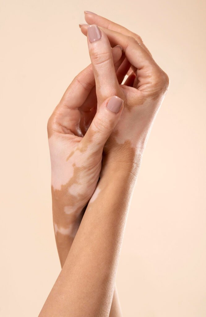 Vitiligo Tedavisi